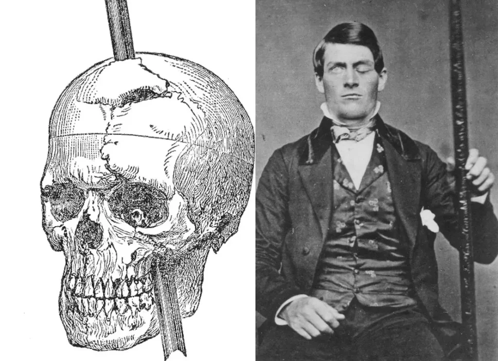 Phineas Gage